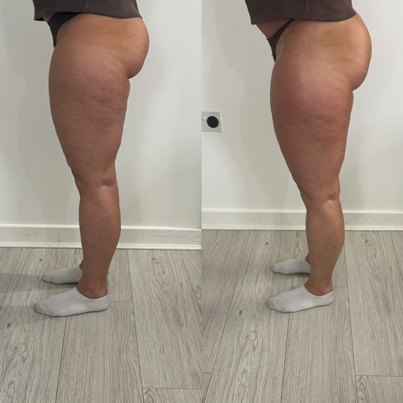Side-view leg treatment result from the NTA Beauty Studio portfolio