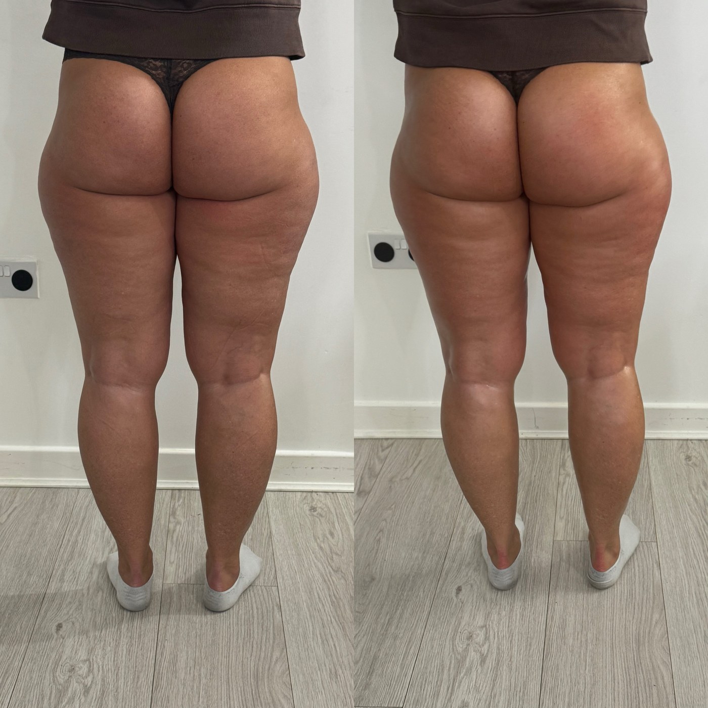 Side-by-side leg contouring result from the NTA Beauty Studio portfolio