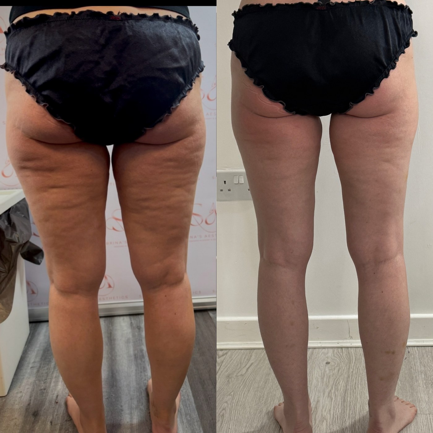 Back-view leg treatment result from the NTA Beauty Studio portfolio