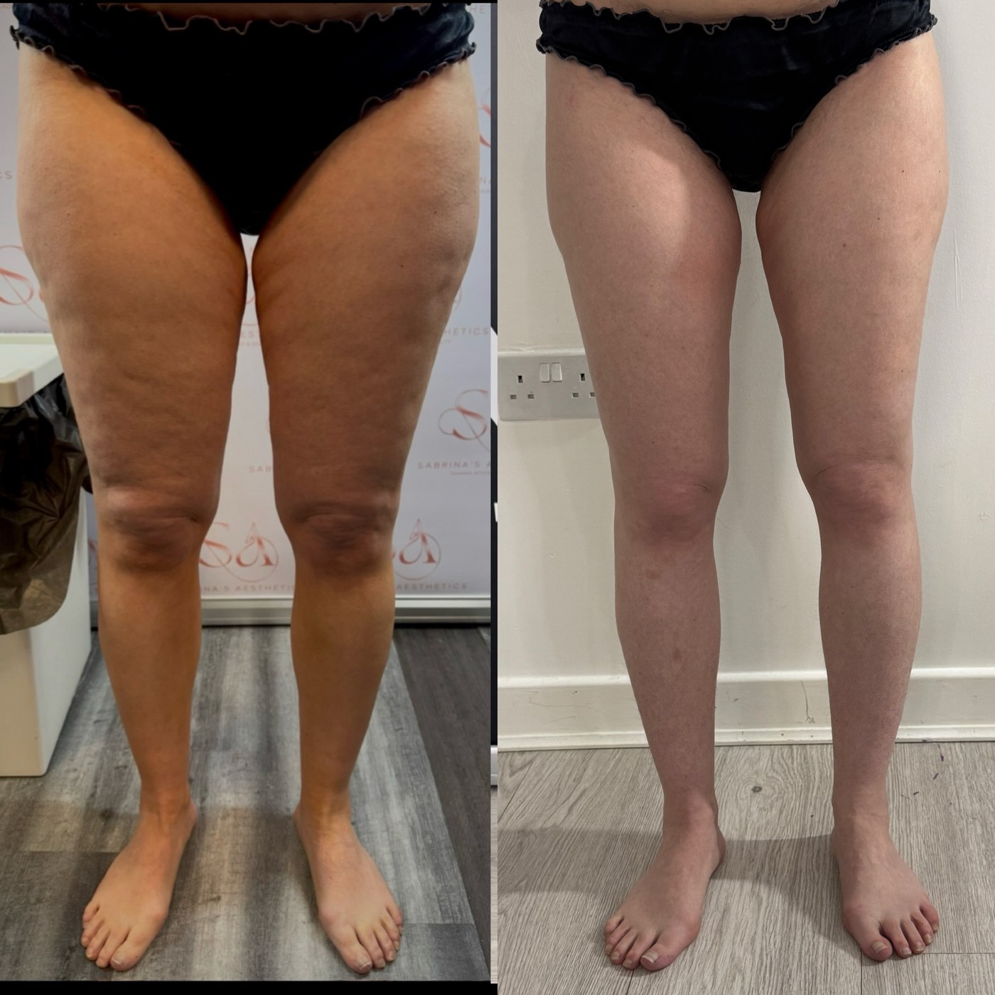 Front-view lower-body result from the NTA Beauty Studio portfolio