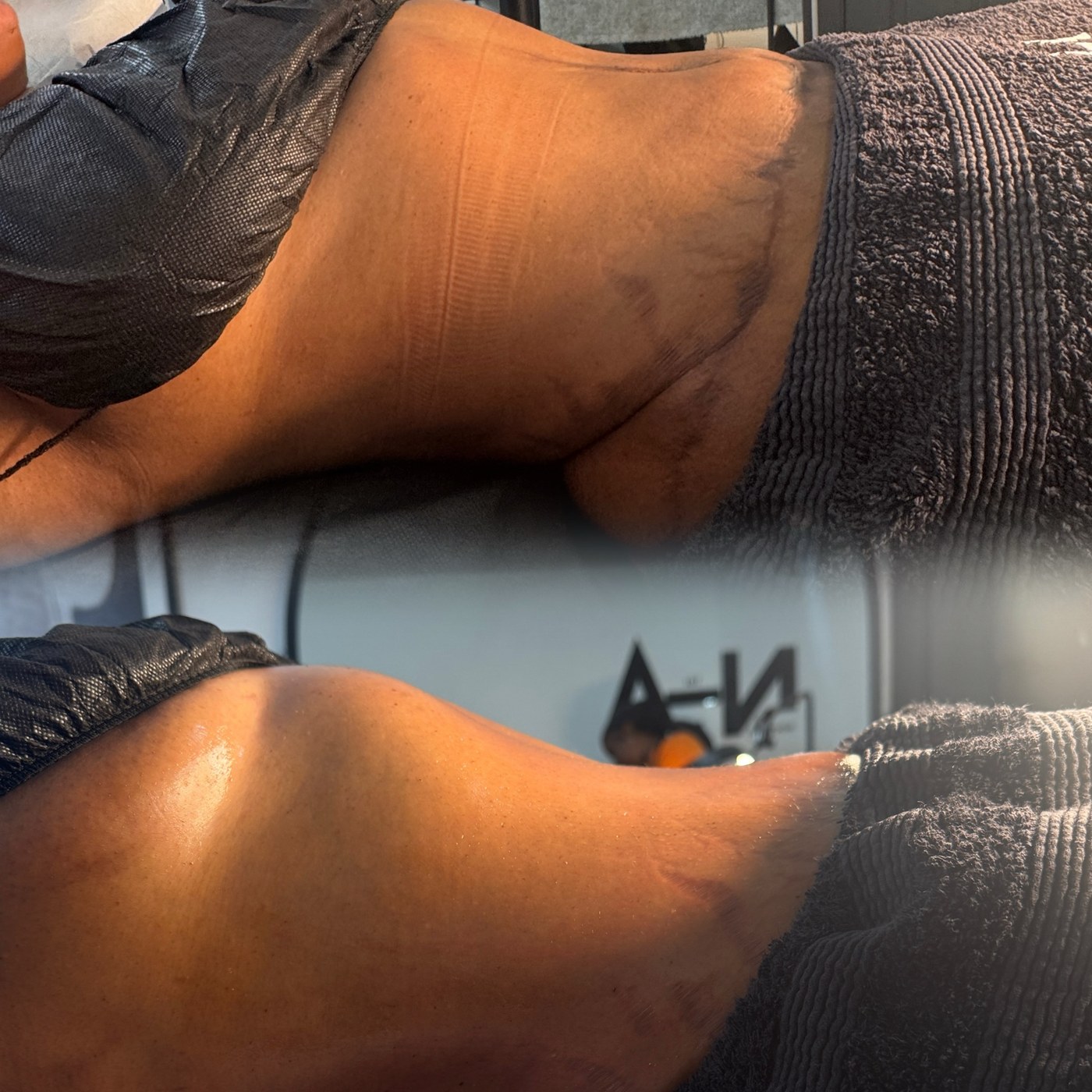 Two-view lower-body treatment comparison from the NTA Beauty Studio portfolio
