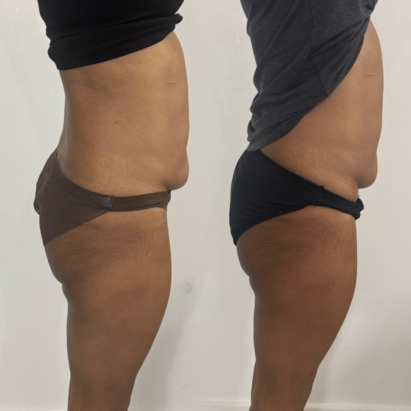 Side-by-side thigh treatment comparison from the NTA Beauty Studio portfolio