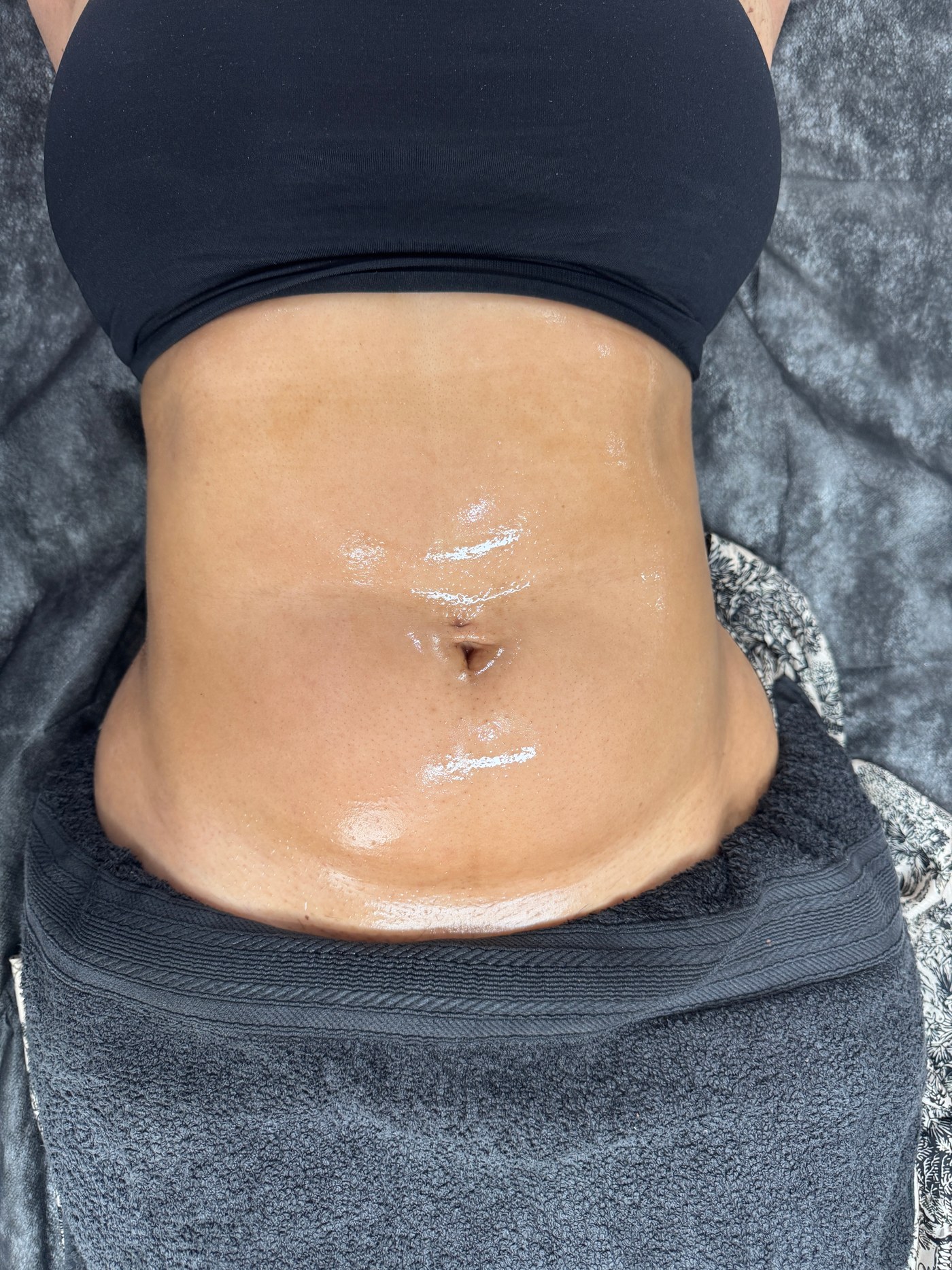 Abdominal treatment result from the NTA Beauty Studio portfolio